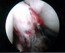 Torn/ruptured ACL viewed at Knee Arthroscopy.