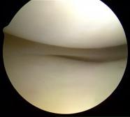 Arthroscopic view of the inside of the knee. The bottom end of the femur and the top end of the tibia are covered in a layer of smooth, white, shiny, glistening articular cartilage.