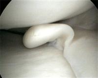 Flap tear of the body of a medial meniscus.
