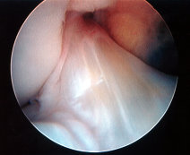 Intact ACL viewed at Knee Arthroscopy.