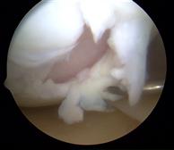 Arthroscopic view of severe articular cartilage damage on a medial femoral condyle.