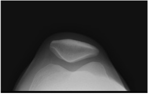 Normal patellar skyline X-ray view, showing V-shaped patella sitting nicely in the middle of the V-shaped trochlear groove.